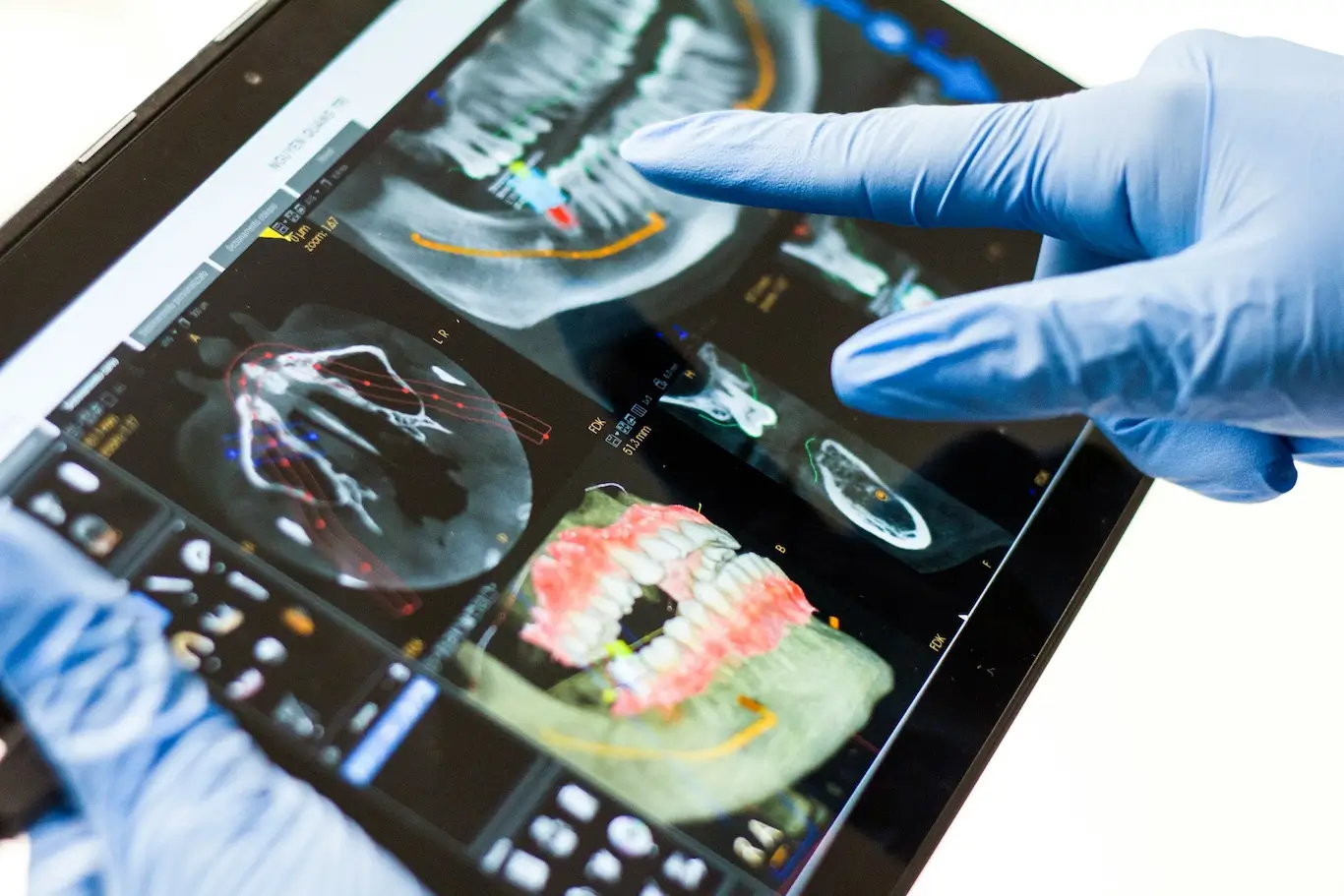 Leczenie kanałowe na obrazku palec stomatologa wskazujący na uzębienie na rentgenie