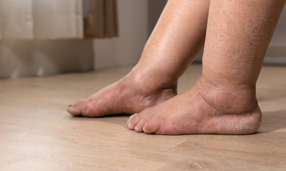 Obrazek główny w wpisie blogowym o tytule: „Puchnięcie nóg - wszystko, co warto wiedzieć kiedy puchną nogi” Na zdjęciu stopy z widocznym obrzękiem i zaczerwienieniem na kostkach, stojące na drewnianej podłodze, wskazujące na problem zdrowotny związanym z puchnięciem nóg.