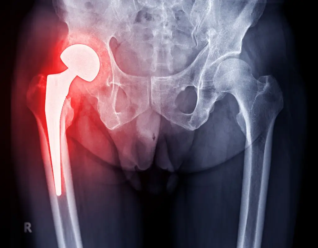 Zdjęcie przedstawia rentgenowskie zdjęcie miednicy i bioder człowieka. Po lewej stronie widoczna jest endoproteza stawu biodrowego – jasna, sztuczna struktura kontrastująca z otaczającymi ją kośćmi. Endoproteza składa się z kulistej głowy stawu oraz długiej, zakotwiczonej w kości udowej części trzpieniowej. Obszar wokół protezy jest zaznaczony czerwonym odcieniem, co może sugerować stan zapalny, podrażnienie lub rekonwalescencję po operacji. Po prawej stronie widoczny jest naturalny staw biodrowy, który nie wykazuje oznak interwencji chirurgicznej. Zdjęcie ma wysoką jakość diagnostyczną, ukazując wyraźnie szczegóły anatomiczne i implant. Jest to obraz medyczny, prawdopodobnie używany w ocenie wyników operacji wymiany stawu biodrowego.