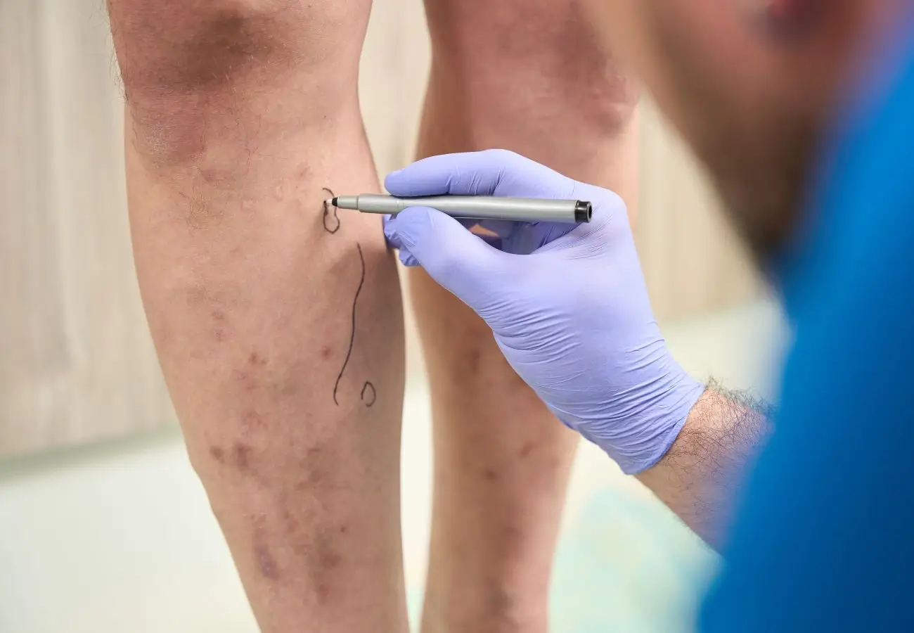 Zdjęcie przedstawia lekarza lub specjalistę medycznego w niebieskim uniformie i fioletowych rękawiczkach ochronnych, który markerem zaznacza miejsca na nodze pacjenta. Skóra pacjenta ma widoczne przebarwienia oraz objawy żylaków lub problemów naczyniowych. Lekarz rysuje linie i oznaczenia, prawdopodobnie przygotowując się do zabiegu lub konsultacji medycznej. Tło jest rozmyte, sugerując wnętrze gabinetu lekarskiego lub kliniki.