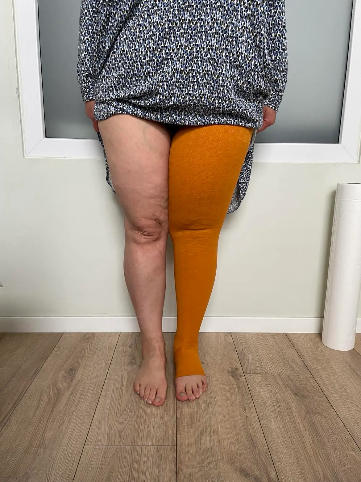 Kobieta stojąca w sukience, prezentująca wyraźną różnicę między obiema nogami – prawa noga opuchnięta i ubrana w pomarańczową pończochę uciskową, lewa w normalnym stanie. Obraz ukazuje efekt obrzęku limfatycznego oraz zastosowanie odzieży kompresyjnej jako elementu terapii po leczeniu onkologicznym.